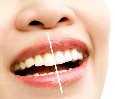 Diş Beyazlatma (Bleaching)